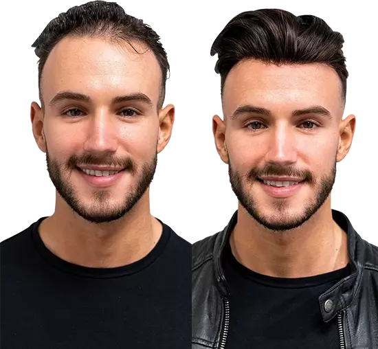 Hair extension specialists in Hyderabad