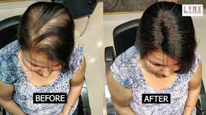 Natural-looking hair replacement Hyderabad
