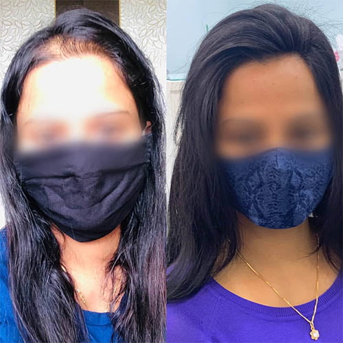 Hair weaving in Hyderabad